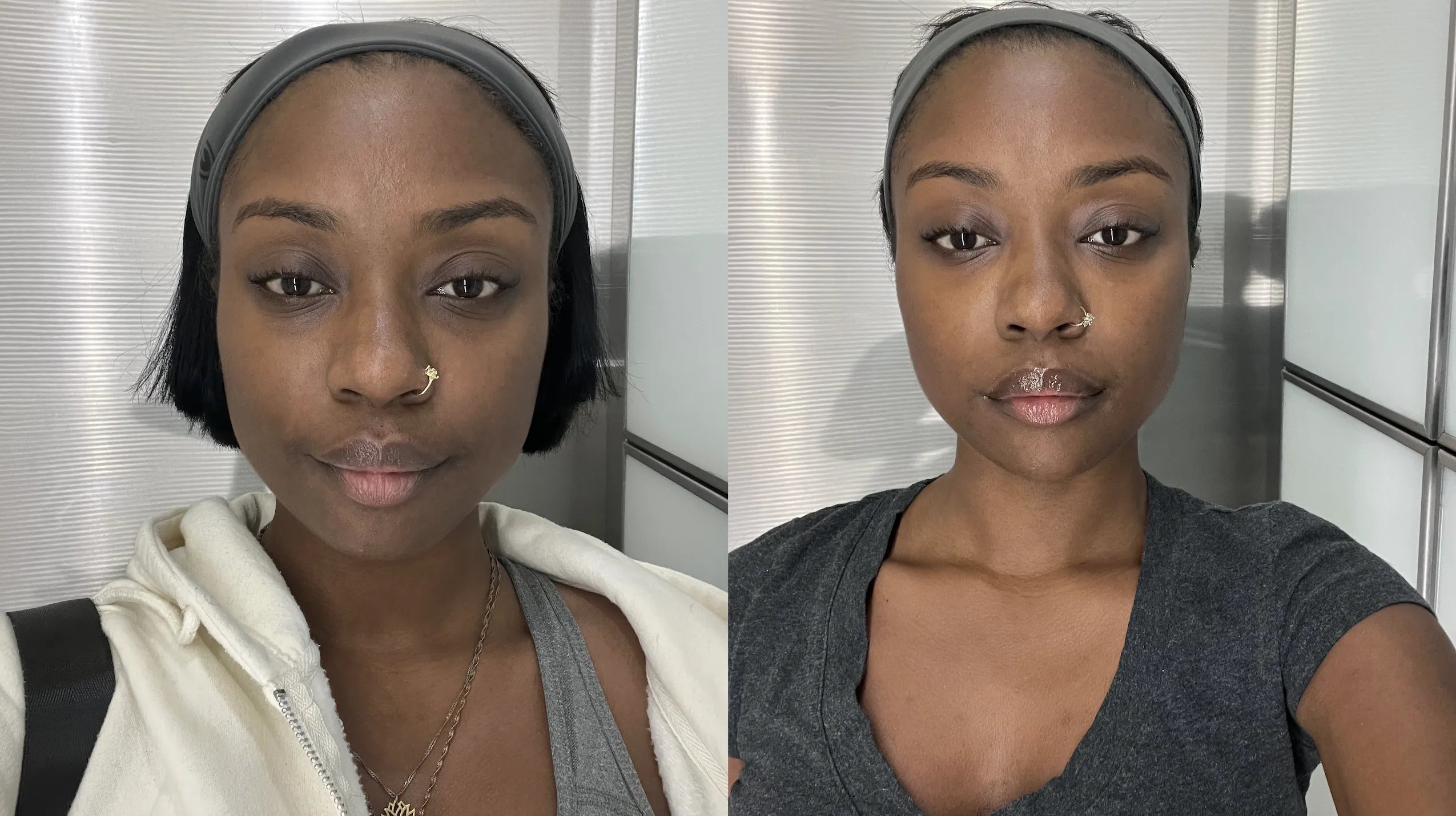 How Facial Balancing Completely Changed My Self-Confidence