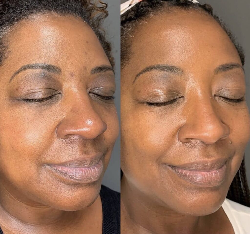 Retinol before and after picture from Instagram account showing how it helped clear up a black woman's complexion.