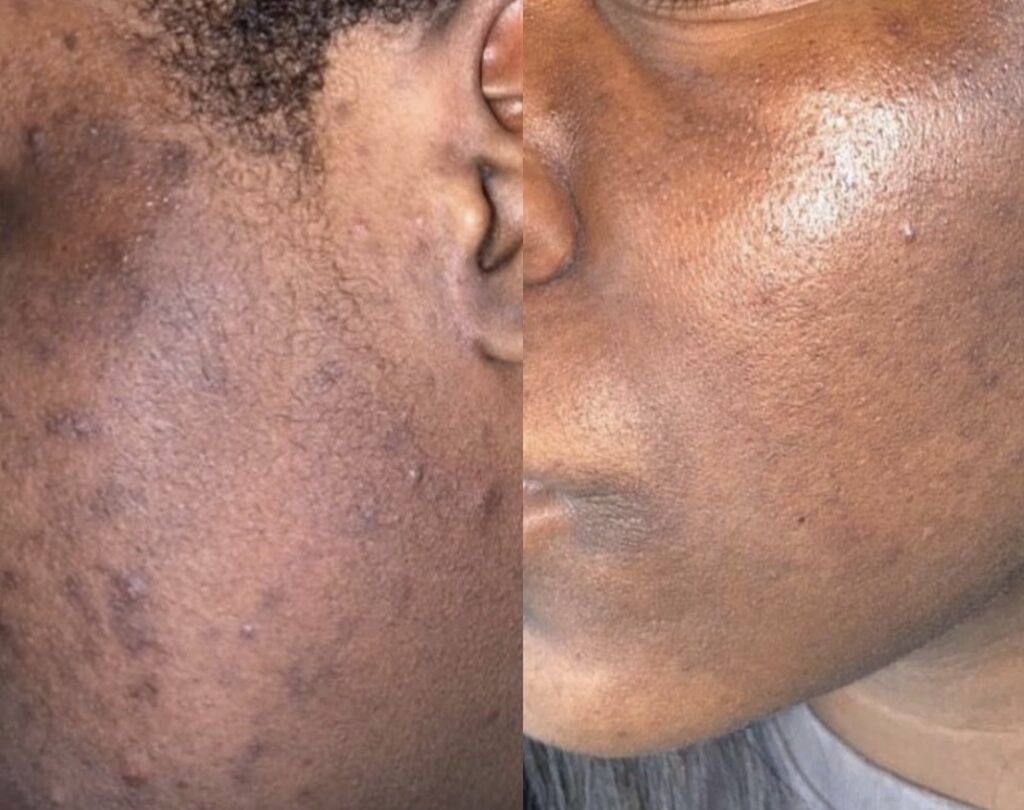Retinol before and after shot on Instagram showing someone's side profile of face.