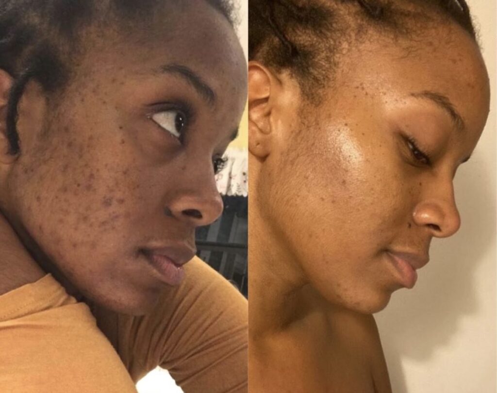 Retinol before and after picture showing how it helps to clear up skin and refine pores.