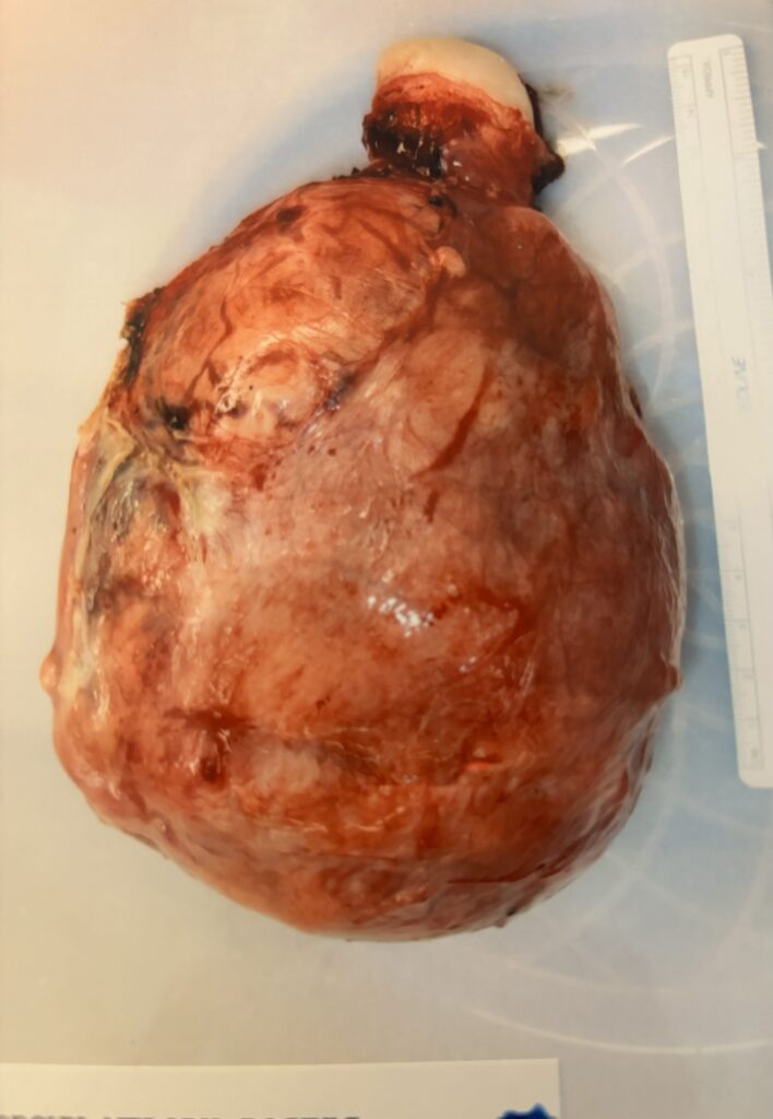 Enlarged uterus removed during hysterectomy.