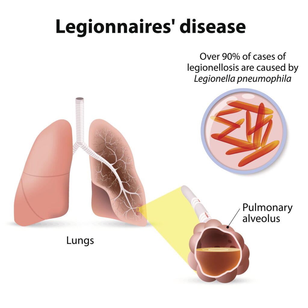 Legionnaires' disease or legionellosis, Legion fever is a form of atypical pneumonia. Legionella pneumophila